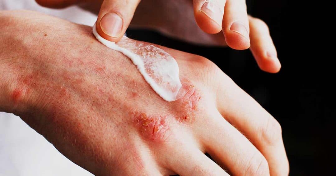 A hand with red, irritated skin from eczema is being treated with a dollop of white cream. Two fingers gently apply the soothing cream, focusing on the affected areas. The dark background highlights the careful application and emphasizes relief for eczema-prone skin.
