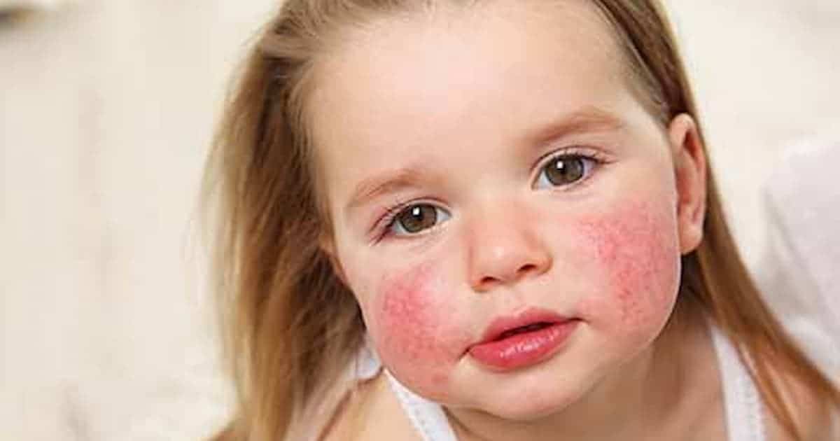 Food Allergies 4 Photo of young girl with a rash on her face
