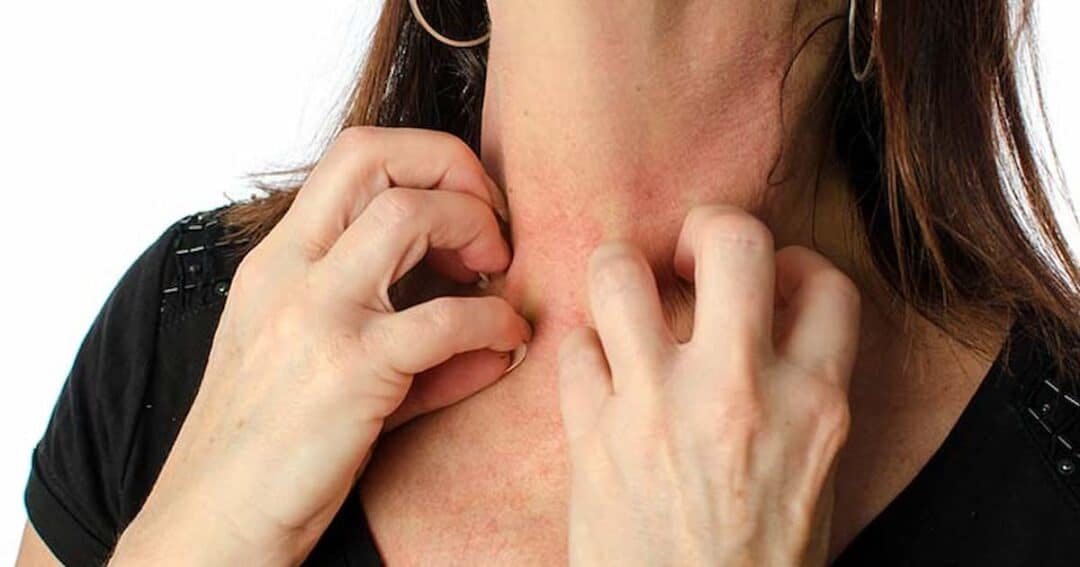 A person scratching their neck with both hands. The skin appears red and irritated. They are wearing a black shirt and have long brown hair. Only the neck and hands are visible.